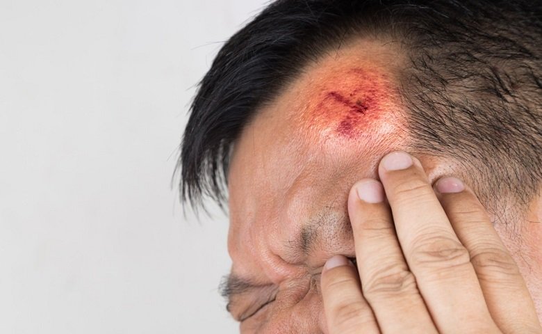 workers comp head injury settlements